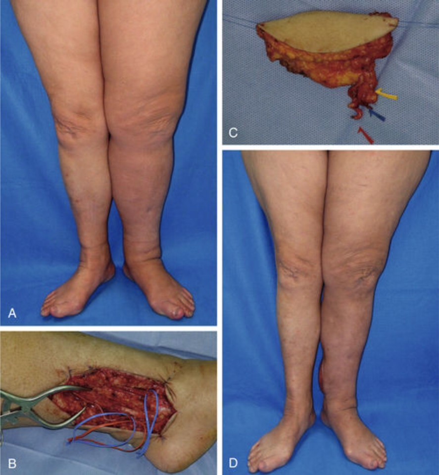 lymph-node-transplantation-1
